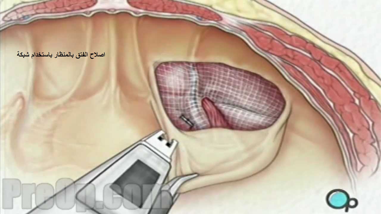 بعد عملية الزايده - فترة نقاهة بعد عملية الزايدة 13164 11