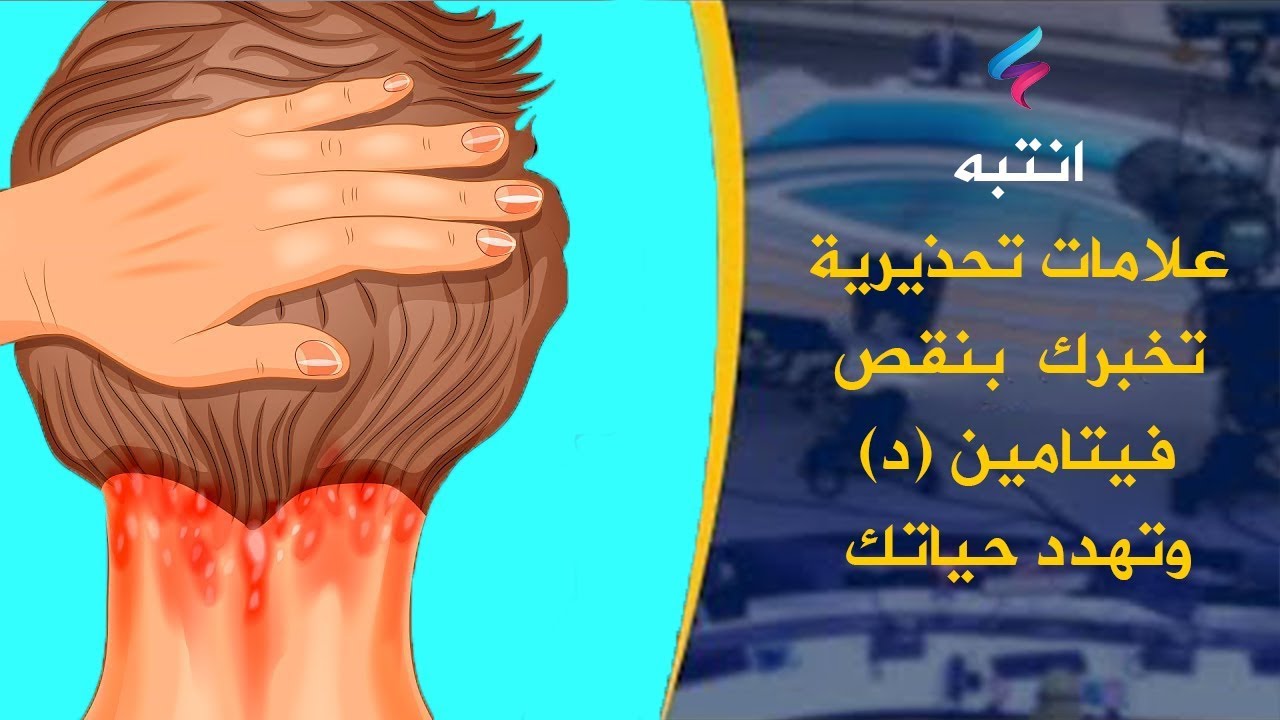 اعراض نقص فيتامين د- تعرفوا على اهم الاعراض لنقص فيتامين د 8917 3