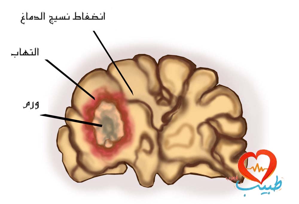 اعراض سرطان المخ عند البالغين - علاج سرطان المخ 13595 2