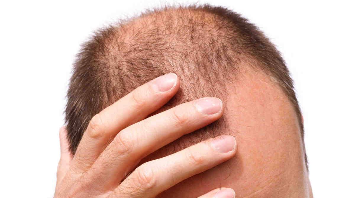 تجربة زراعة الشعر في تركيا بالصور - الحل موجود في تركيا 755 13