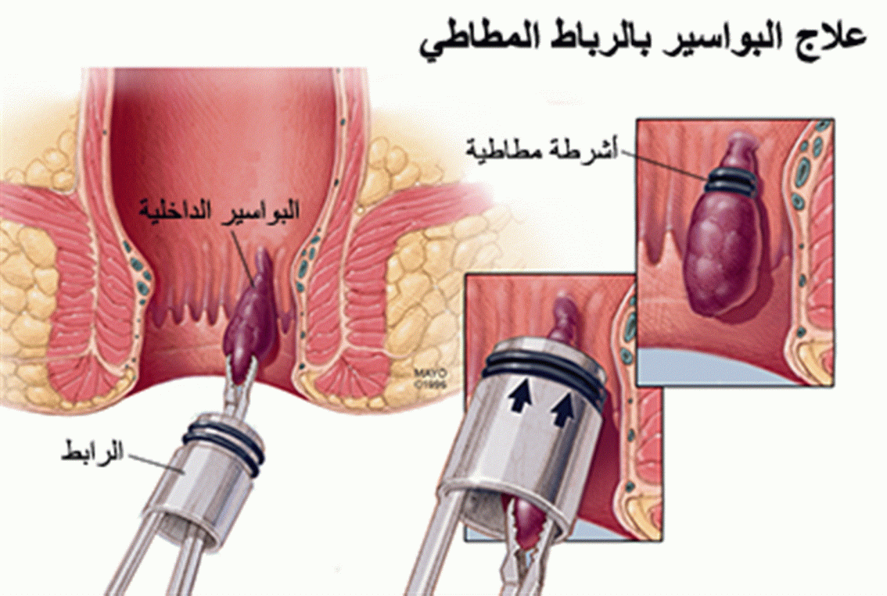 افضل طريقة لعلاج البواسير - طرق طبيعية لعلاج البواسير 13346