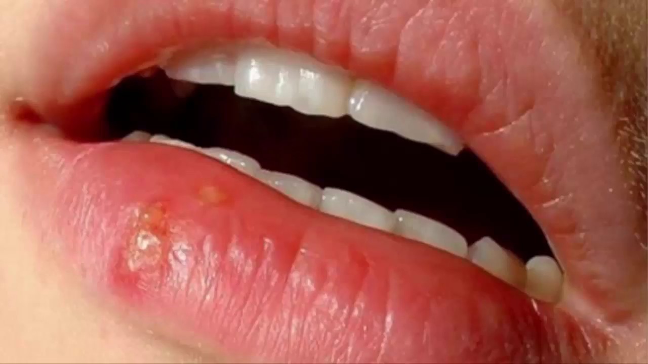 12888 2 علاج حبة السخونة في الفم - اسباب وعلاج حبة السخونة في الفم ميامين موسى